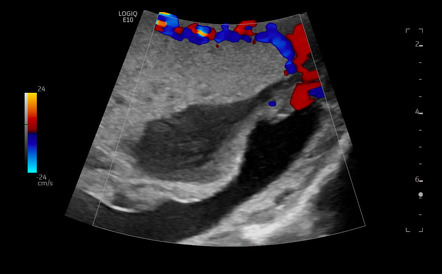 Placental lakes | Image | Radiopaedia.org