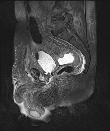 Vesicocutaneous fistula | Image | Radiopaedia.org