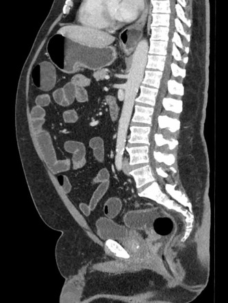 Rectal adenocarcinoma | Radiology Case | Radiopaedia.org