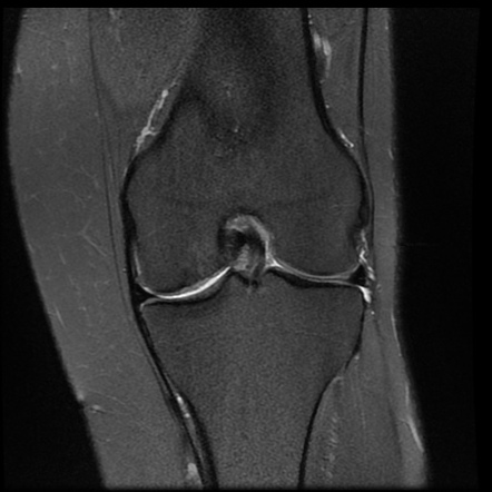 Osteochondral defect - stage IV | Image | Radiopaedia.org