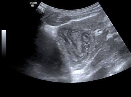 Hepatic hydatid cyst - water-lily sign | Image | Radiopaedia.org