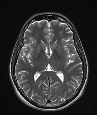 Oculomotor nerve (cranial nerve III) palsy | Radiology Case ...