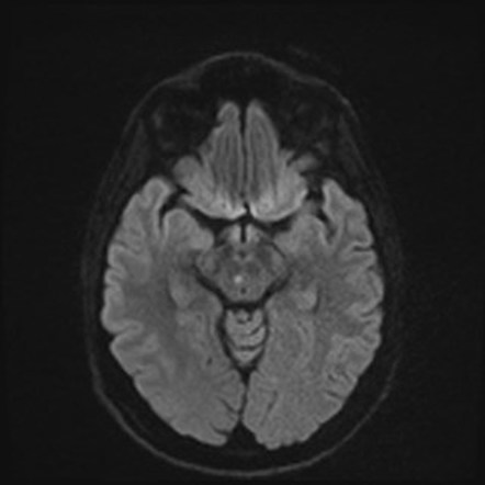 Oculomotor Nerve Palsy Radiology Reference Article Ra - vrogue.co