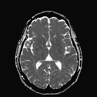 Oculomotor nerve (cranial nerve III) palsy | Image | Radiopaedia.org