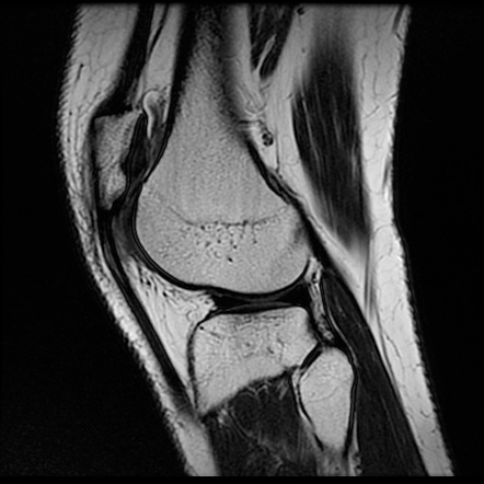 Patellar tendon-lateral femoral condyle friction syndrome | Image ...