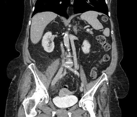 Duplicated inferior vena cava filter placement | Image | Radiopaedia.org