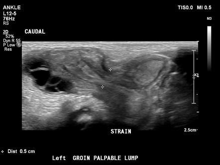 Canal of Nuck hernia containing ovary | Radiology Case | Radiopaedia.org