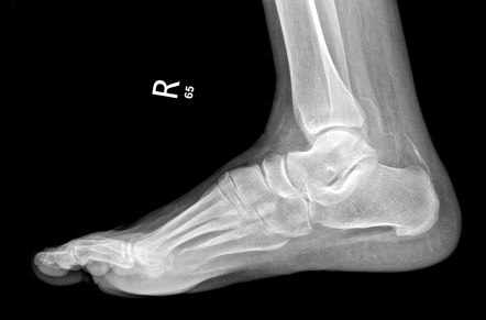 Calcaneal tuberosity avulsion fracture | Radiology Reference Article ...