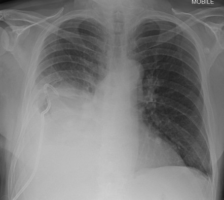 Thoracic empyema | Radiology Case | Radiopaedia.org