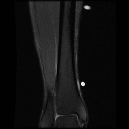 Medial Tibial Stress Syndrome Radiology Case Radiopaedia Org