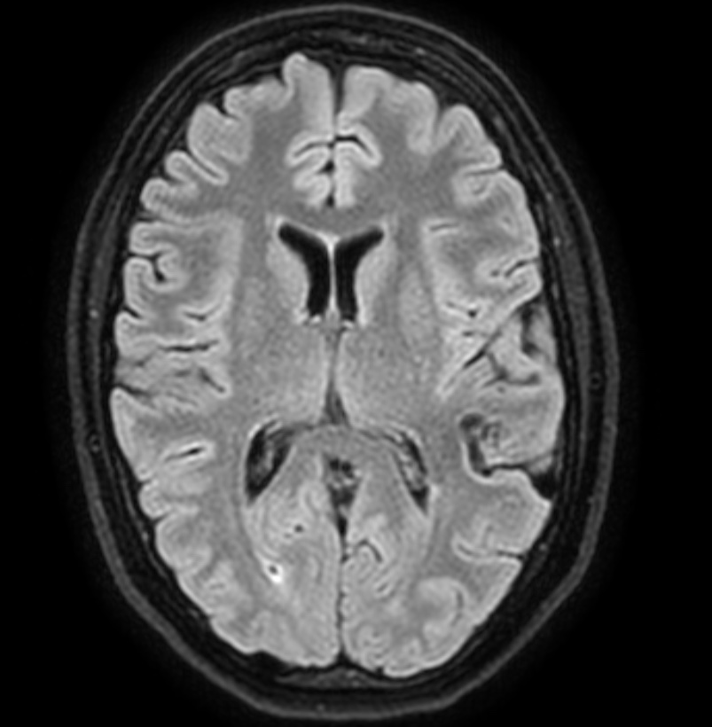 Cerebral arteriovenous malformation | Image | Radiopaedia.org