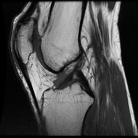 Iliotibial band friction syndrome | Image | Radiopaedia.org