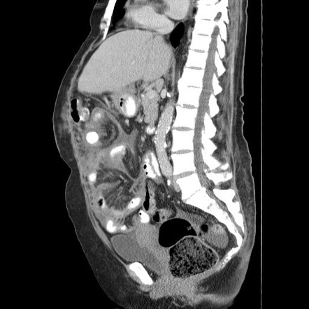 Peritoneal extramedullary hematopoesis | Image | Radiopaedia.org