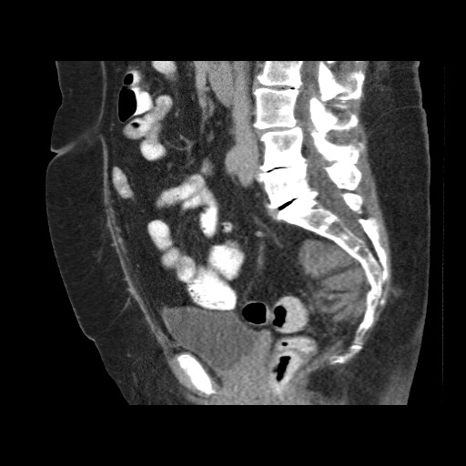 Presacral extra-adrenal myelolipoma | Image | Radiopaedia.org