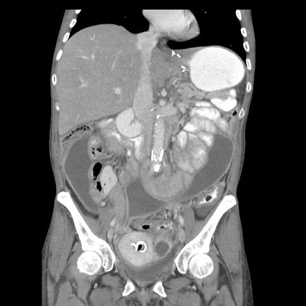 Pelvic actinomycosis infection | Radiology Reference Article ...