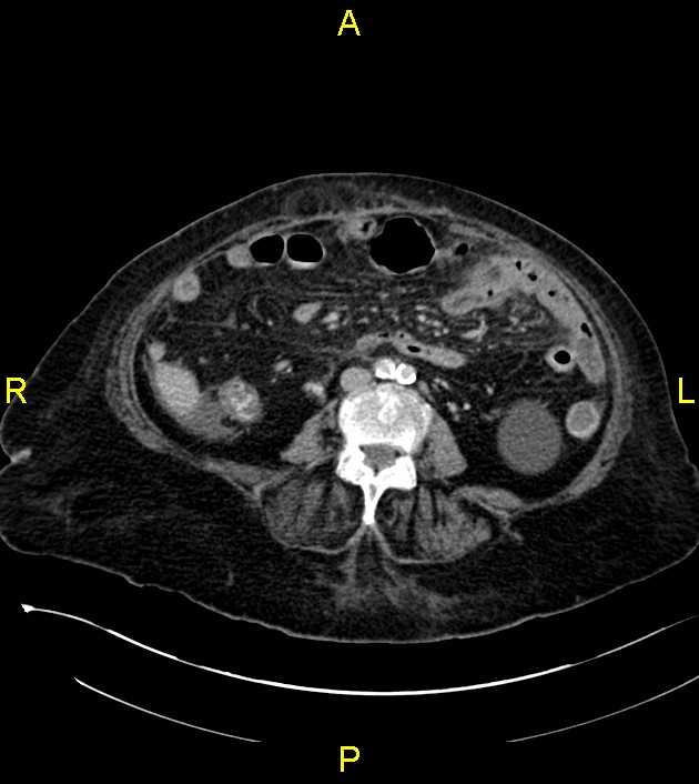 malignant-mixed-mullerian-tumor-of-the-uterus-image-radiopaedia