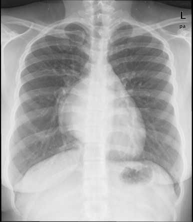 Bronchogenic cyst | Radiology Reference Article | Radiopaedia.org