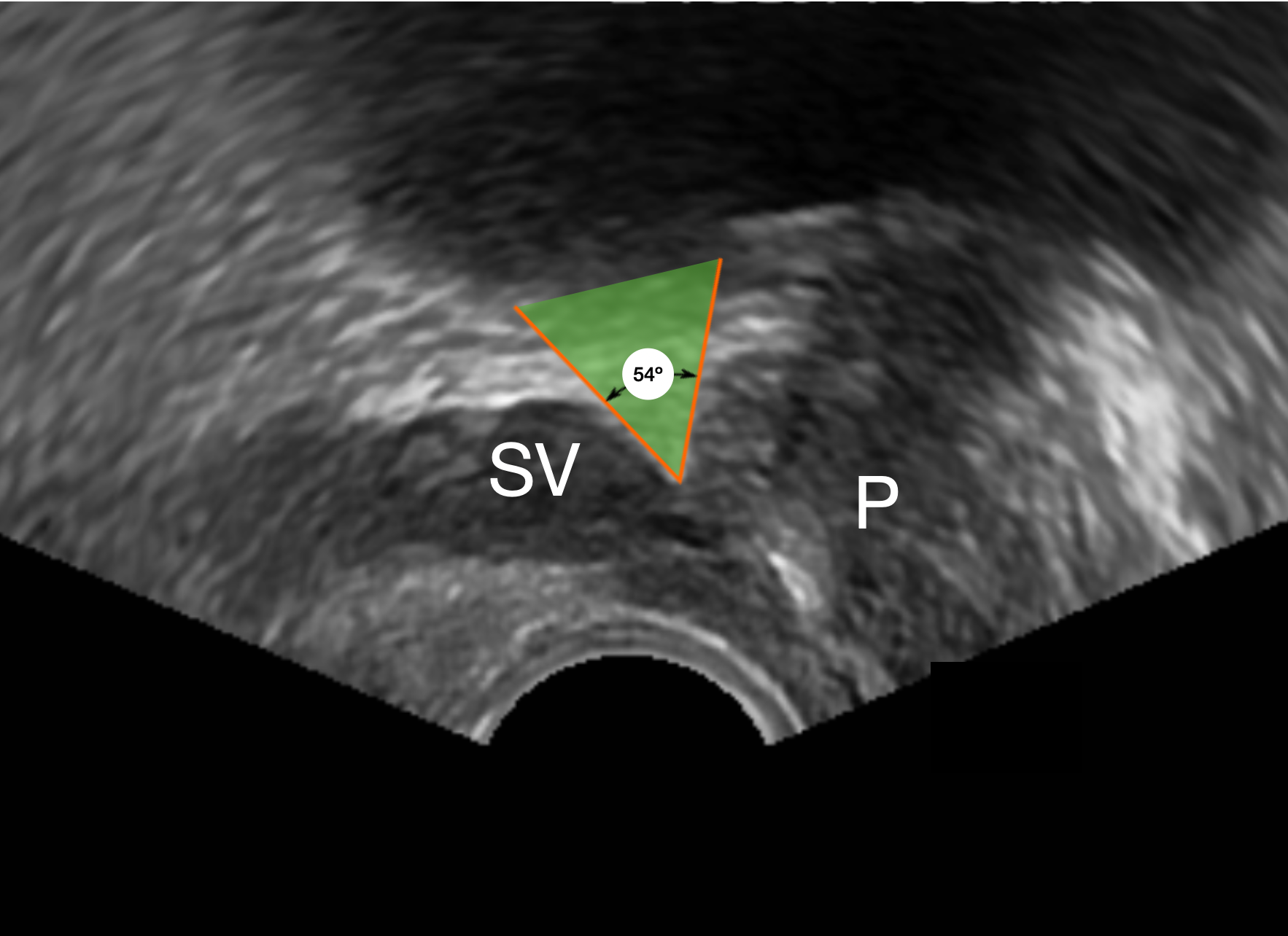 Prostate-seminal Vesicle Angle (TRUS) | Image | Radiopaedia.org