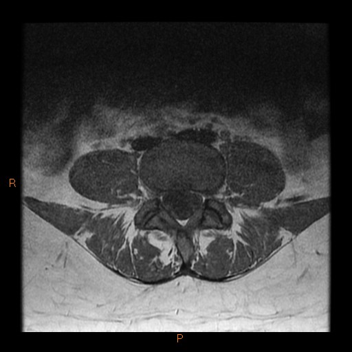 Normal Spinal Mri