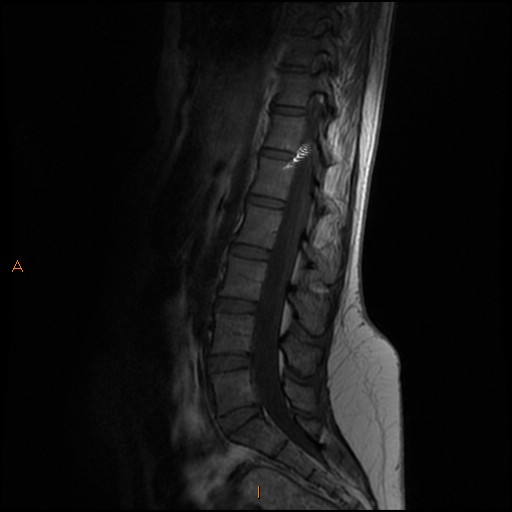 Normal spine MRI | Image | Radiopaedia.org