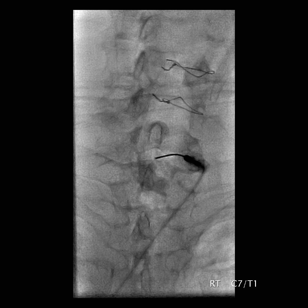 Cervical Interlaminar Epidural Steroid Injection Fluoroscopic Guided Image Radiopaedia Org