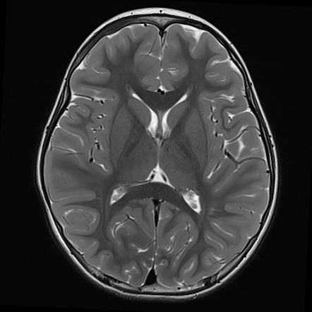 McCune-Albright syndrome with polyostotic fibrous dysplasia | Image ...