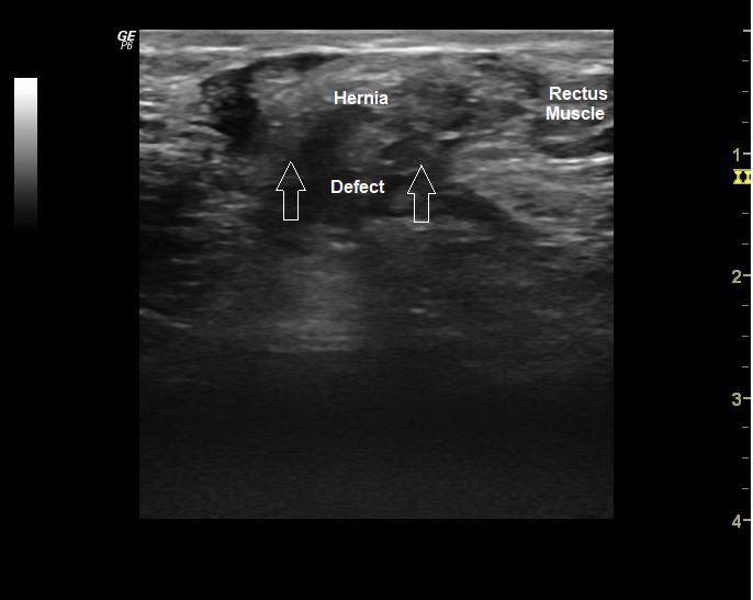 Ventral Hernia Ultrasound