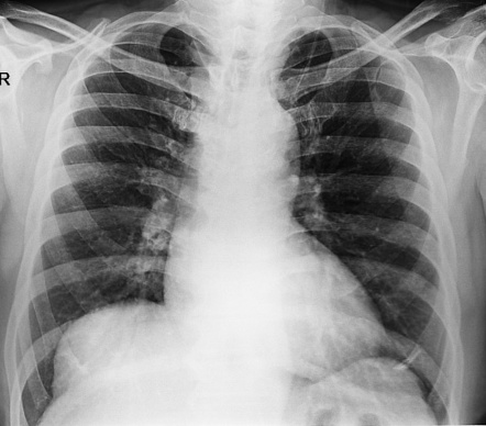 Diaphragmatic eventration - bilateral | Radiology Case | Radiopaedia.org