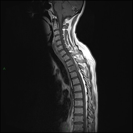 Pancoast tumor | Radiology Case | Radiopaedia.org