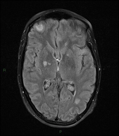 Malignant melanoma cerebral metastases | Image | Radiopaedia.org