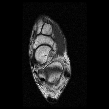 Distal tibia and calcaneum and stress fractures | Image | Radiopaedia.org