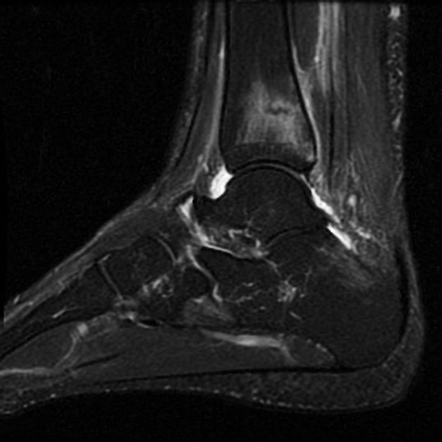 Haglund Syndrome Radiology Reference Article Radiopaedia Org