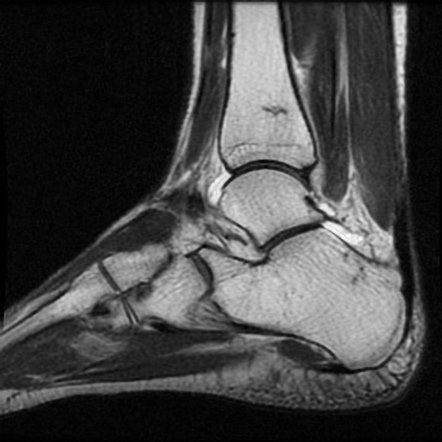 Distal tibia and calcaneum and stress fractures | Image | Radiopaedia.org