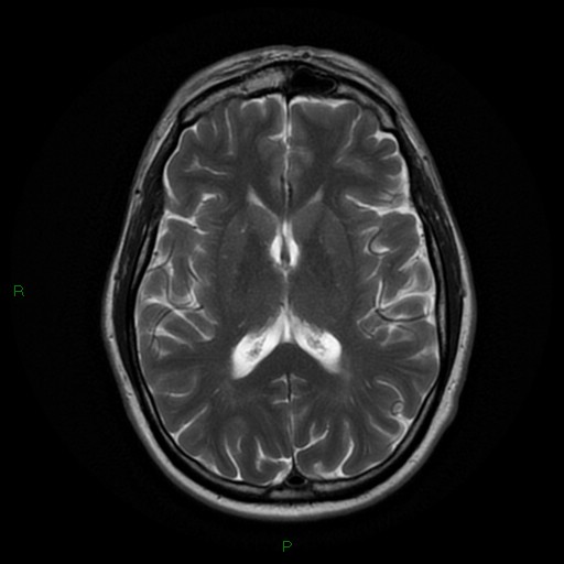 Foville syndrome | Image | Radiopaedia.org