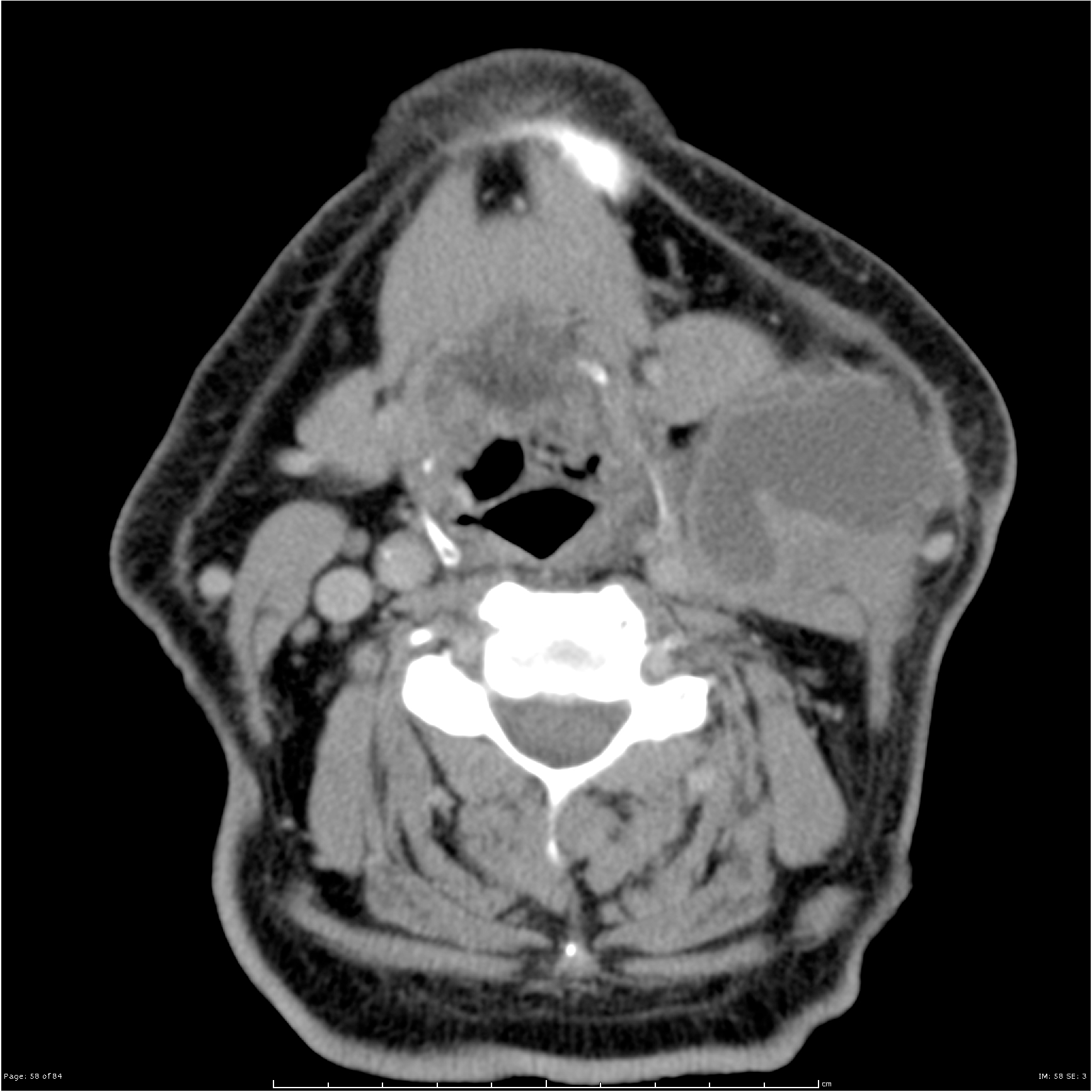 Left superficial neck abscess | Image | Radiopaedia.org