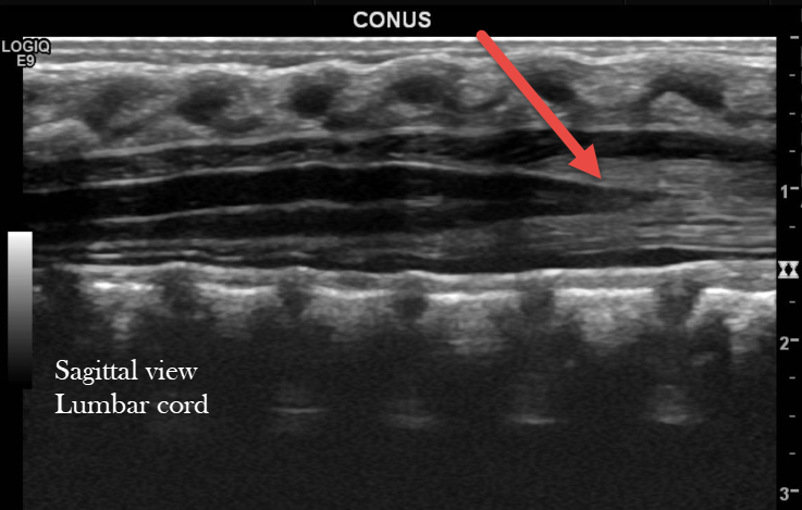 Normal Neonatal Spine Ultrasound Image 