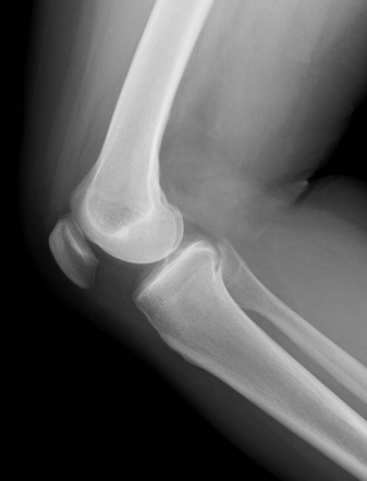 Third head of gastrocnemius | Image | Radiopaedia.org