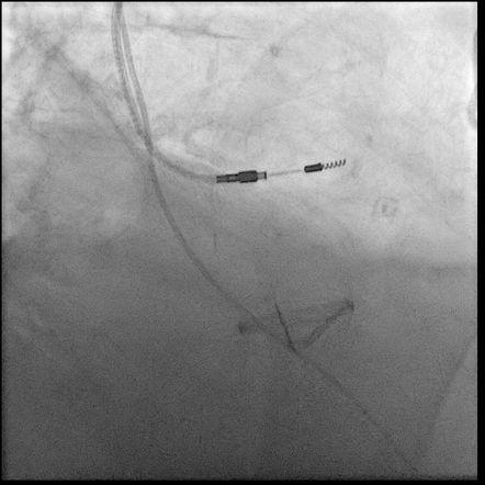 Prosthetic Heart Valve Radiology Reference Article Radiopaedia Org