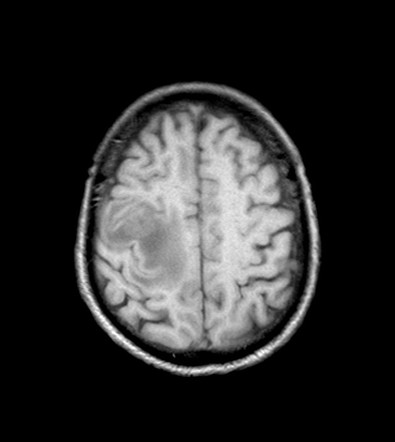 Primary CNS Lymphoma | Image | Radiopaedia.org