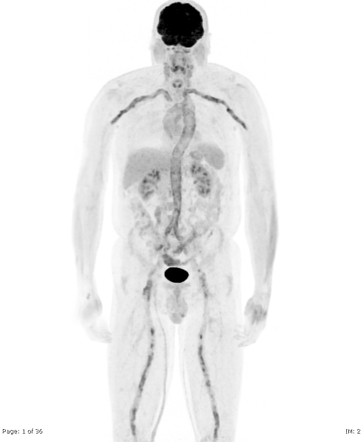 Vasculitis Screen