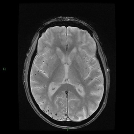 Cerebral Amyloid Angiopathy | Image | Radiopaedia.org