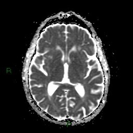 Cerebral amyloid angiopathy | Image | Radiopaedia.org