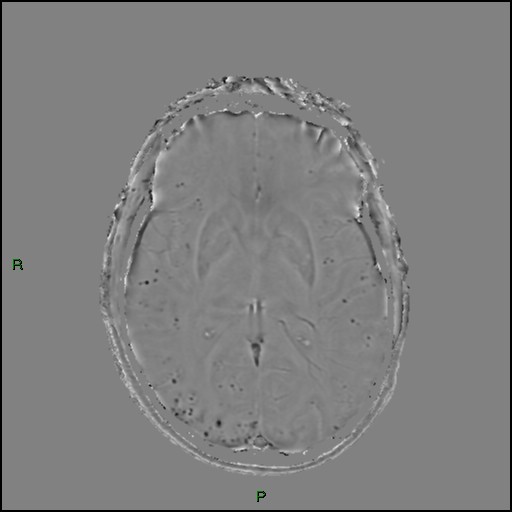 Cerebral amyloid angiopathy | Image | Radiopaedia.org