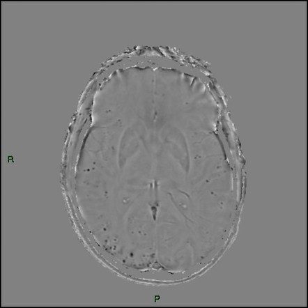 Cerebral Amyloid Angiopathy | Image | Radiopaedia.org