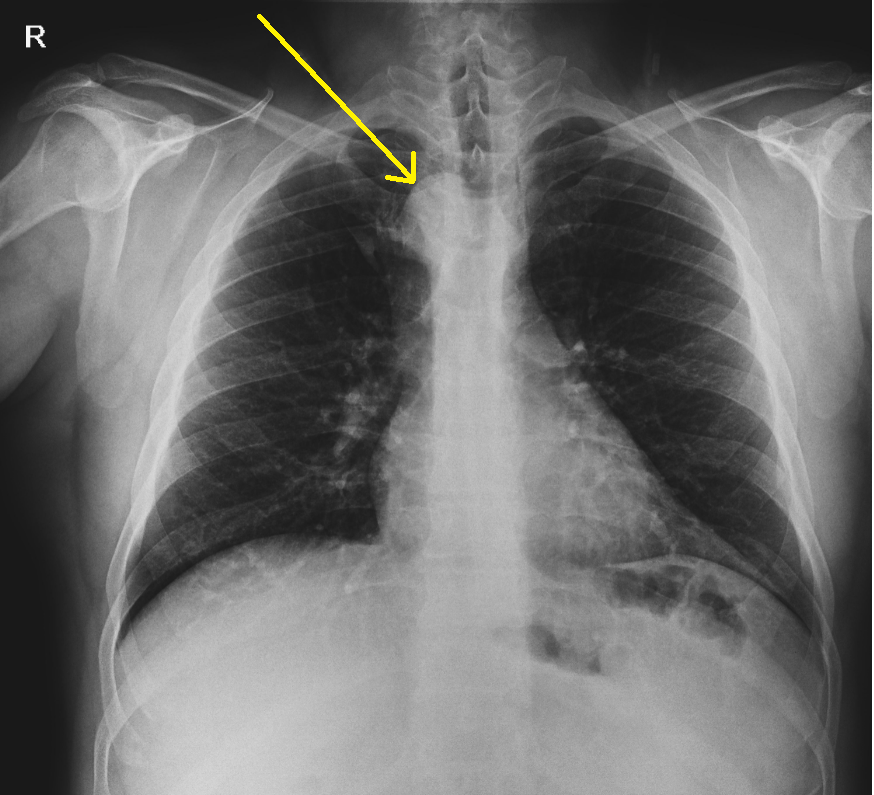 Double aortic arch | Image | Radiopaedia.org