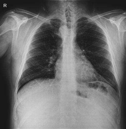 Double aortic arch | Radiology Reference Article | Radiopaedia.org