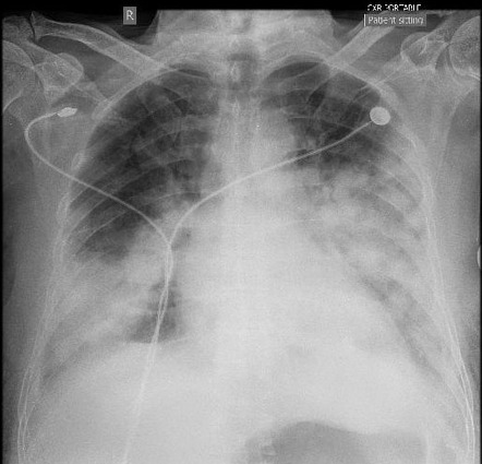 COVID-19 pneumonia | Radiology Case | Radiopaedia.org