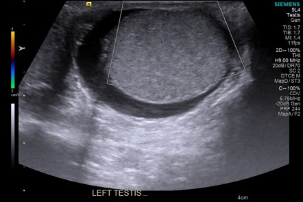 Spontaneous testicular detorsion | Radiology Case | Radiopaedia.org