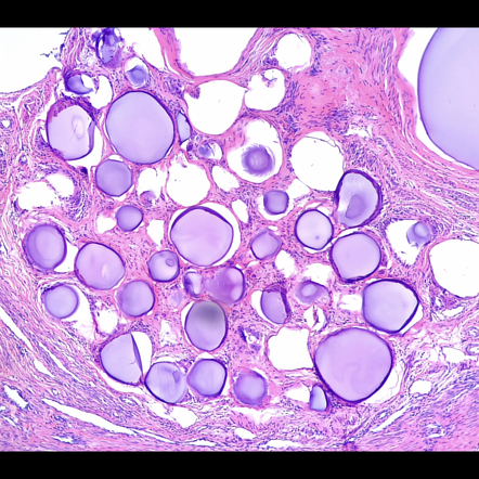 Uterine Artery Embolization