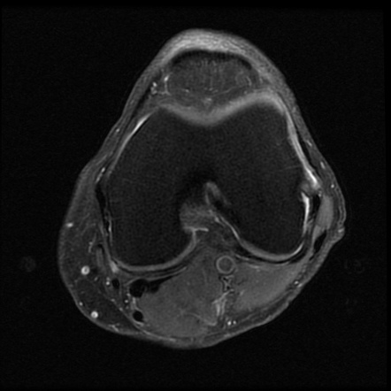 Anomalous Insertion Of The Medial Meniscus 